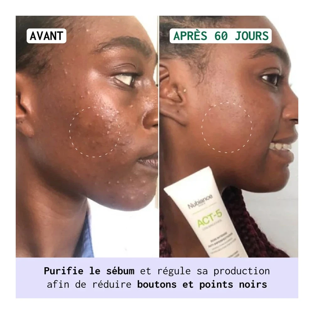 Soin Intense Anti-imperfections ACT-5 30ml 2 Soin Intense Anti-imperfections ACT-5 30ml – Image 2